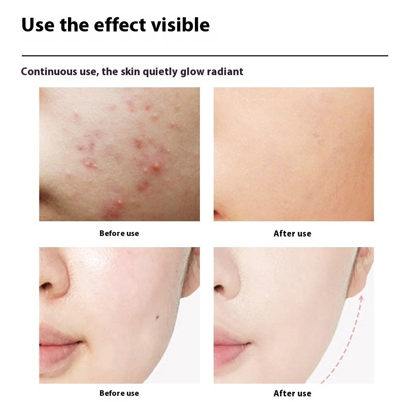 Before and after results of using Photon Specific Skincare Device for skin rejuvenation.