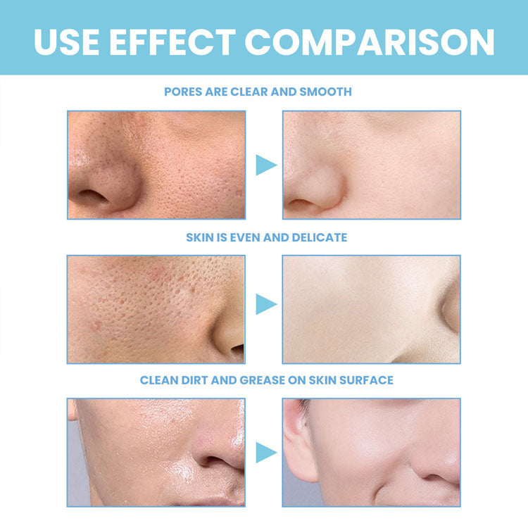 Comparison of facial skin showing the effects of using a brightening foaming facial cleanser, highlighting clear pores and even skin tone.