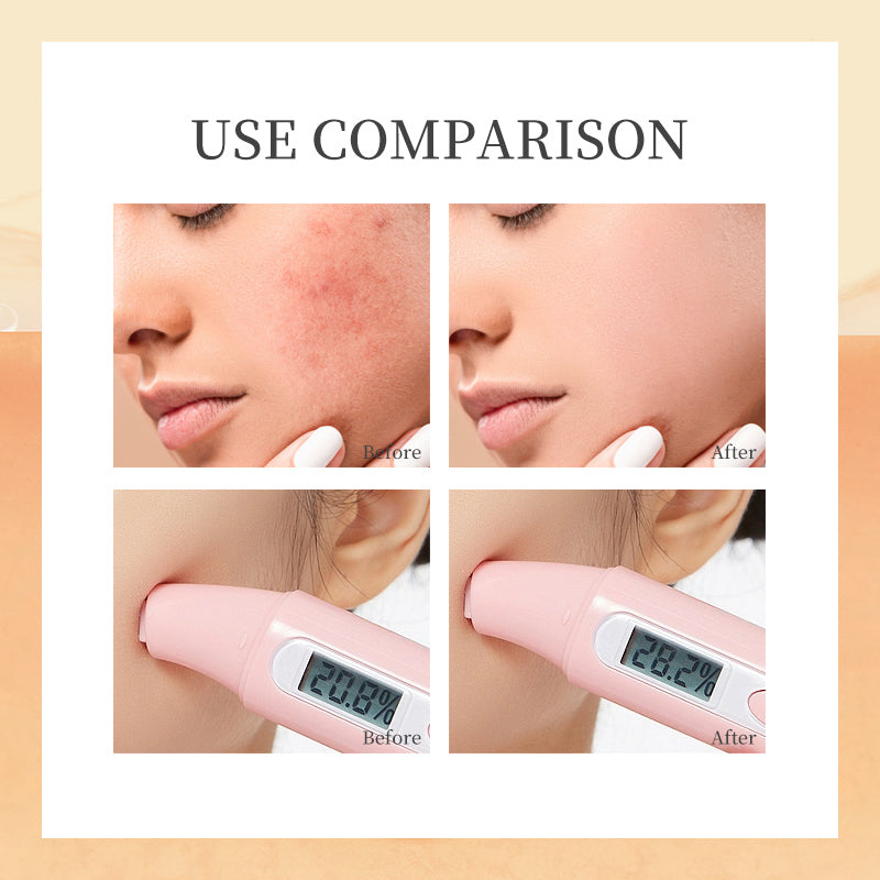 Use comparison of anti-acne cream cleanser showing before and after results on skin.